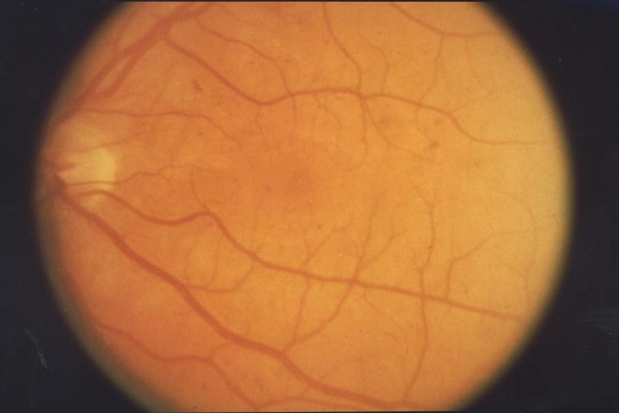 Fundus Retinopathy NEI